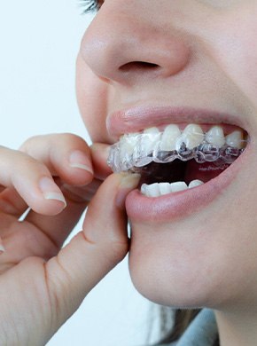 Nose-to-chin closeup of someone removing Invisalign from upper arch