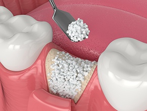 A 3D illustration of dental bone grafting