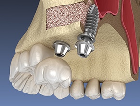 A 3D illustration of implants placed via sinus lift surgery