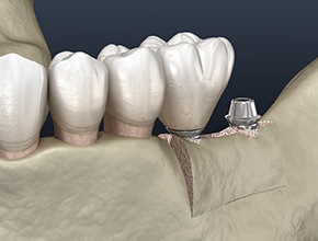 A 3D illustration of a ridge expansion