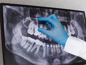 A dental X-ray highlight the cost of a root canal in Manchester 