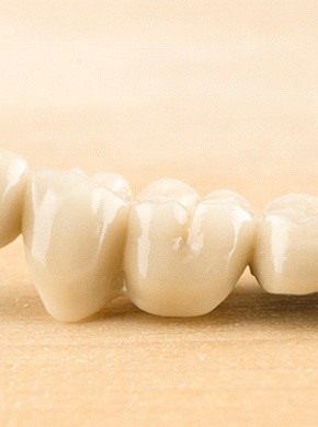 Dental bridge and crowns
