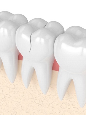 illustration of a cracked tooth in Manchester