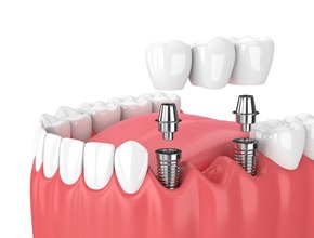 implant bridge in Manchester