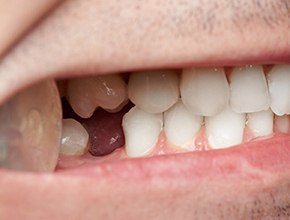 Closeup of a missing tooth