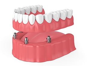 Diagram of an implant denture in Manchester.