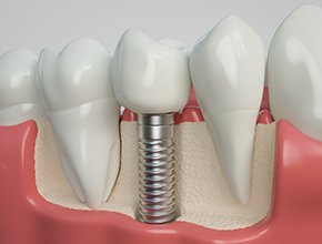 Dental implant in Manchester, NH with a crown