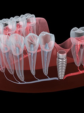 A 3D illustration of a failed dental implant