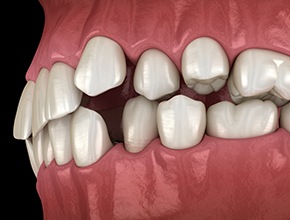 Illustration of gapped teeth