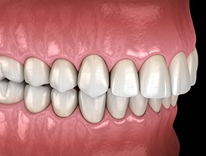 Illustration of an overbite