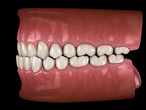 Illustration of an underbite