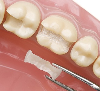 A dentist placing an inlay into a dental model.