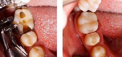 Before and after metal-free restorations in Manchester are placed.