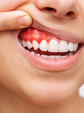 Woman with red, swollen gums in Dallas