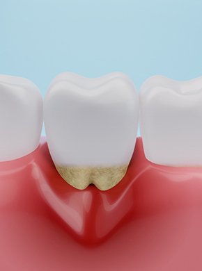 Infected and swollen gum tissues