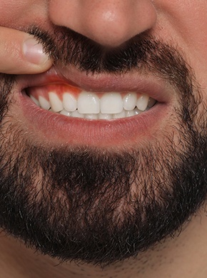Man suffering from red and tender gum tissue