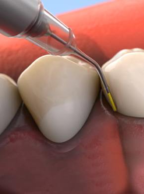 Animation of Arestin antibiotic therapy process