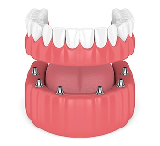 Digital model of implant-retained dentures.