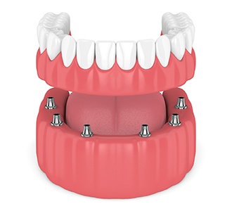 Digital model of implant-retained dentures.