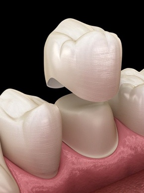 diagram of dental crown being placed over tooth