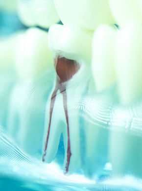 Model of root canal in Manchester