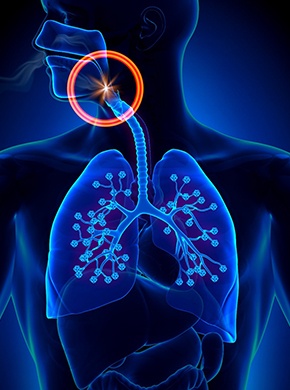 Illustration of an airway obstruction during sleep apnea