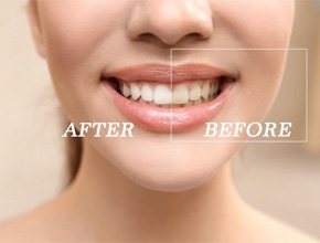 before and after for cost of teeth whitening Manchester  