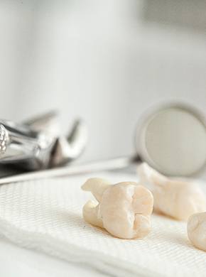 Extracted wisdom teeth on a table 