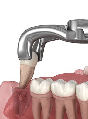An illustration of a wisdom tooth being removed