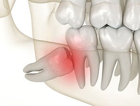 Illustration of fully impacted wisdom tooth
