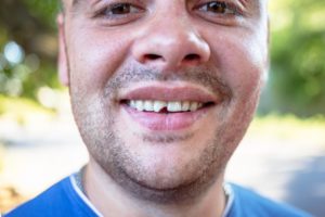 a man with a chipped tooth