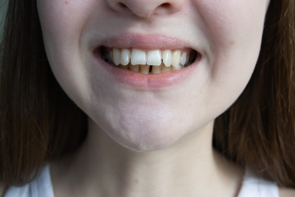 Image of a person with an overbite smiling