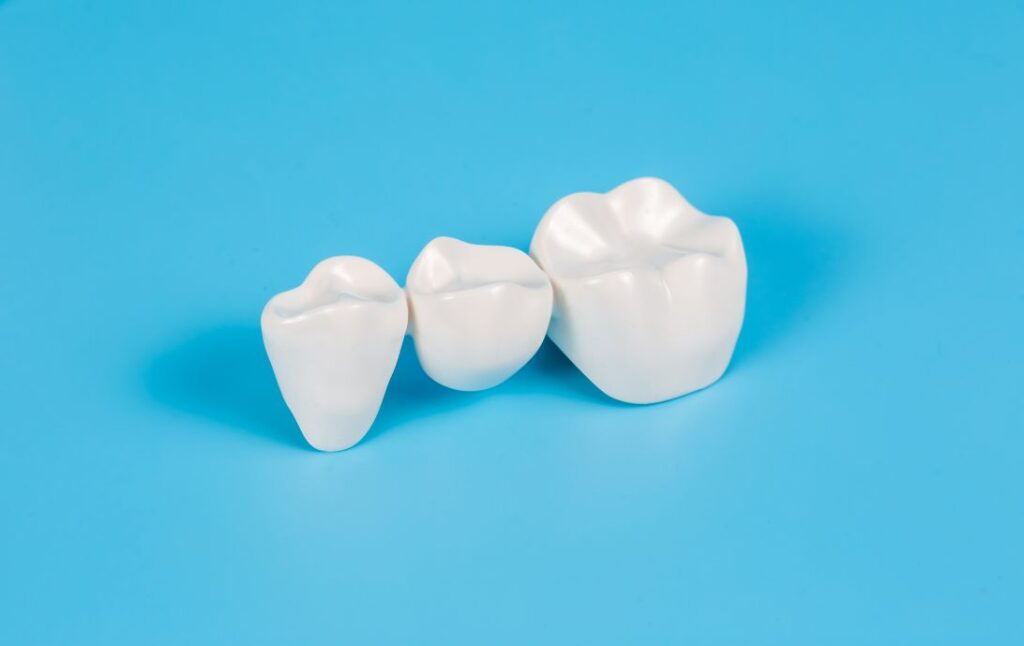how-long-will-my-dental-bridge-last