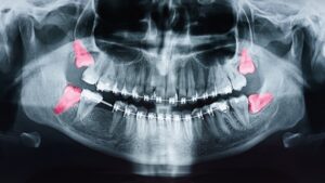 X-ray showing wisdom teeth.